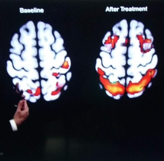 A man is pointing to the same image of two brains.